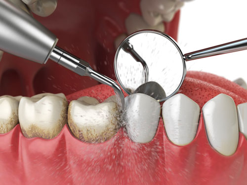 Gum Disease Treatment From a Dental Hygienist