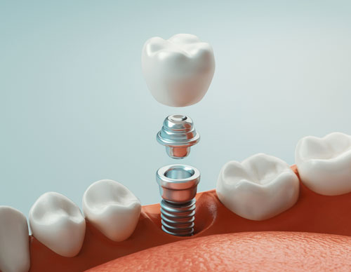 dental implants