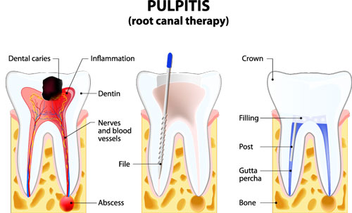 Root Canals Diagram