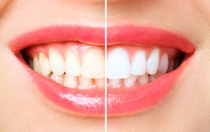 Teeth Whitening Process