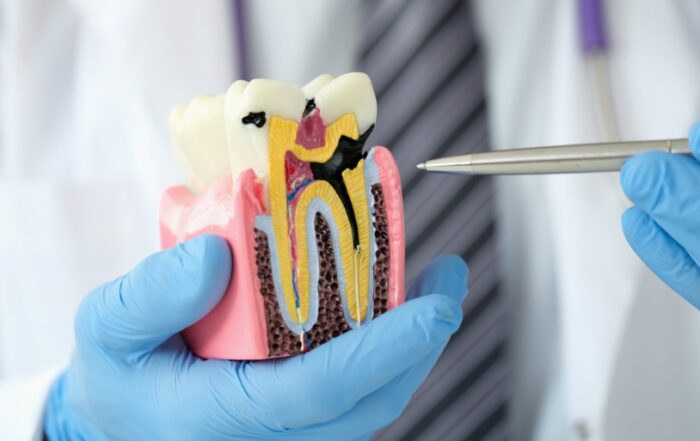 Brighter Smiles Family Dentistry in West Des Moines explaining how to prevent cavities in children using a tooth decay model